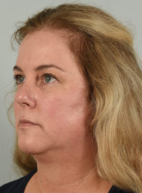 Fractional co2 Laser case #4490