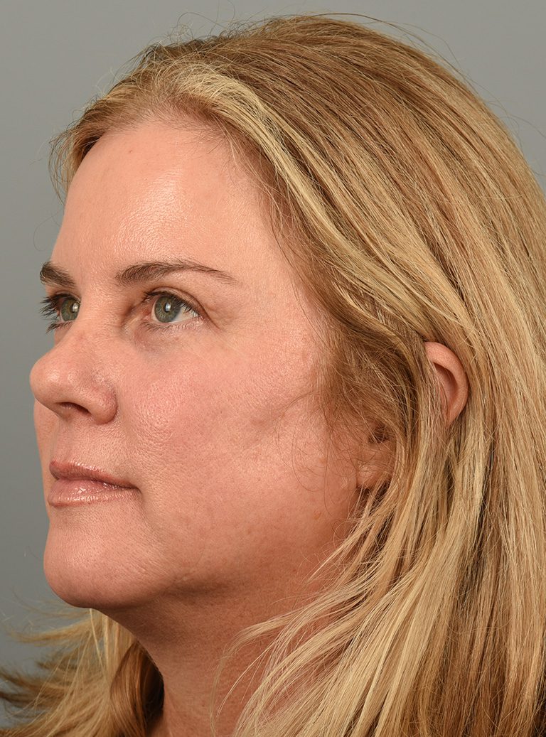 Fractional co2 Laser case #4490