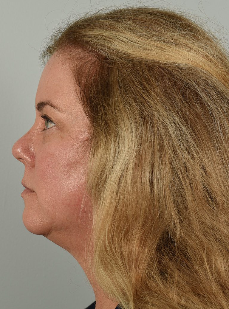 Fractional co2 Laser case #4490