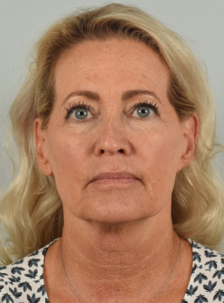 Facelift case #4261
