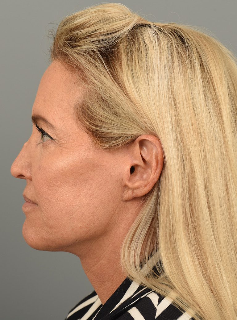 Facelift case #4261