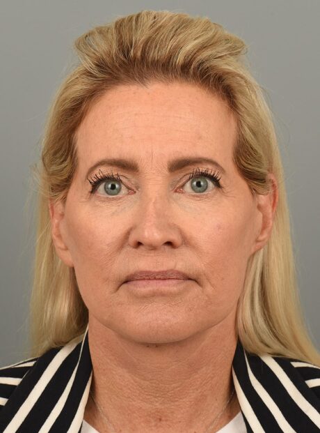 Facelift case #4261