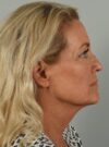 Facelift case #4261
