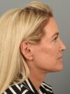 Facelift case #4261