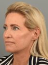 Facelift case #4261