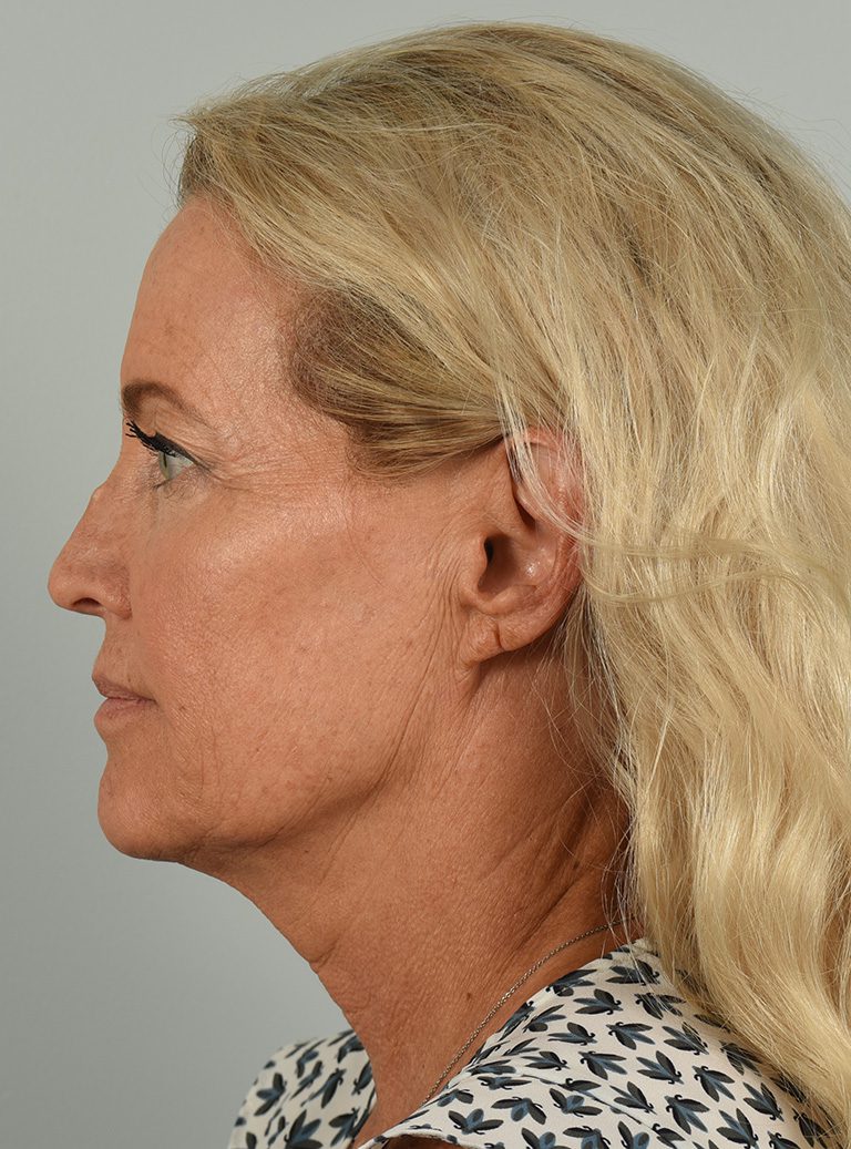 Facelift case #4261