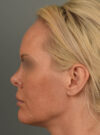 Facelift case #11530