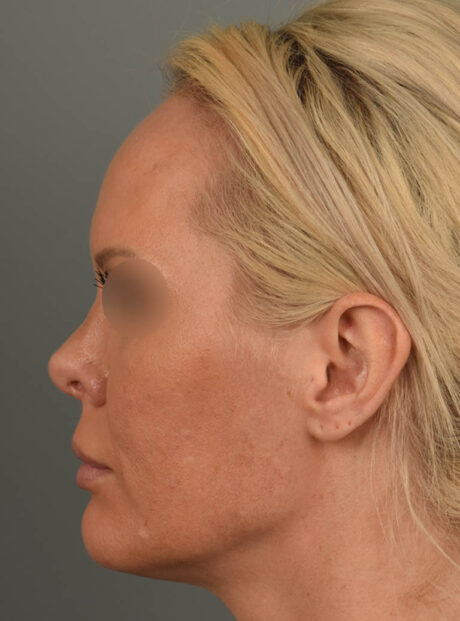 Facelift case #11530