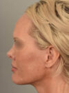 Facelift case #11530