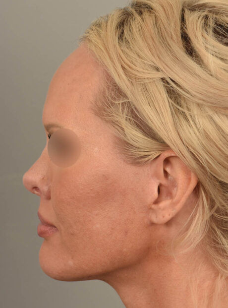 Facelift case #11530