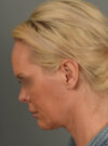 Facelift case #11530
