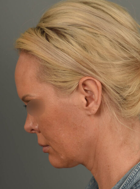 Facelift case #11530