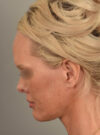 Facelift case #11530