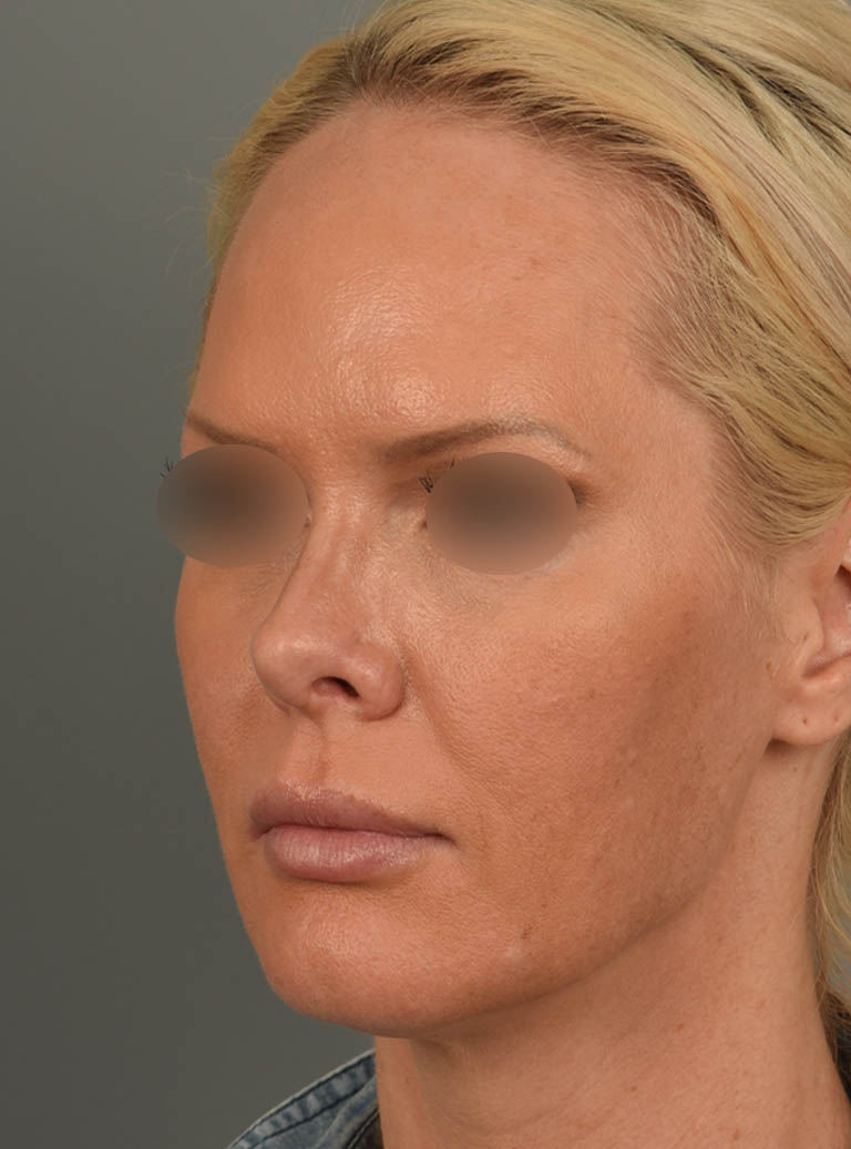 Facelift case #11530