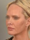 Facelift case #11530