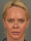 Facelift case #11530