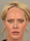 Facelift case #11530
