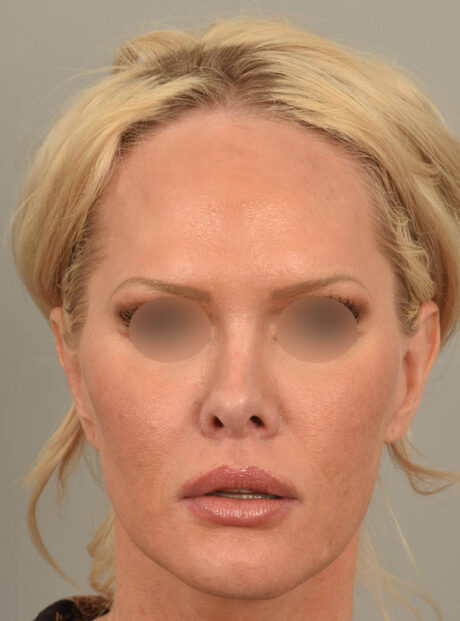 Facelift case #11530