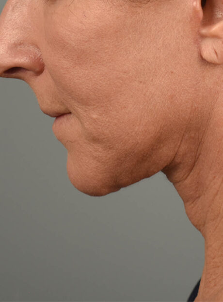 Facelift case #11414