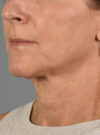 Facelift case #11414