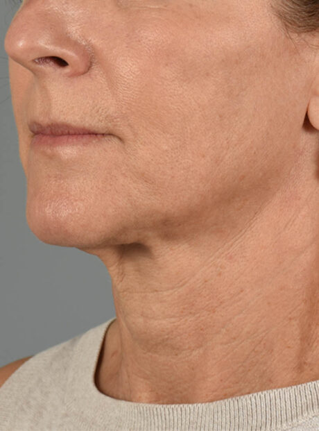 Facelift case #11414