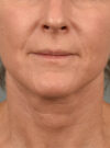 Facelift case #11414