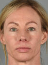 Eyelid Surgery case #11801