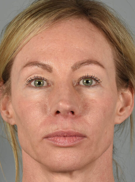 Eyelid Surgery case #11801