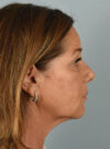 Eyelid Surgery case #11400
