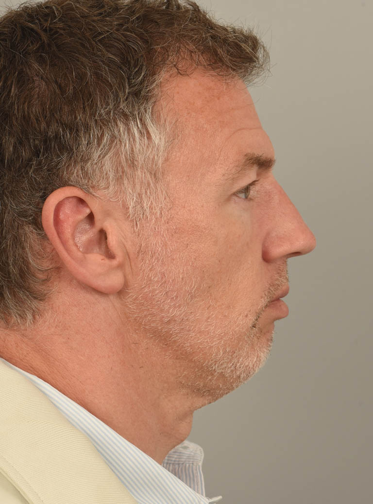 Chin Augmentation case #11371