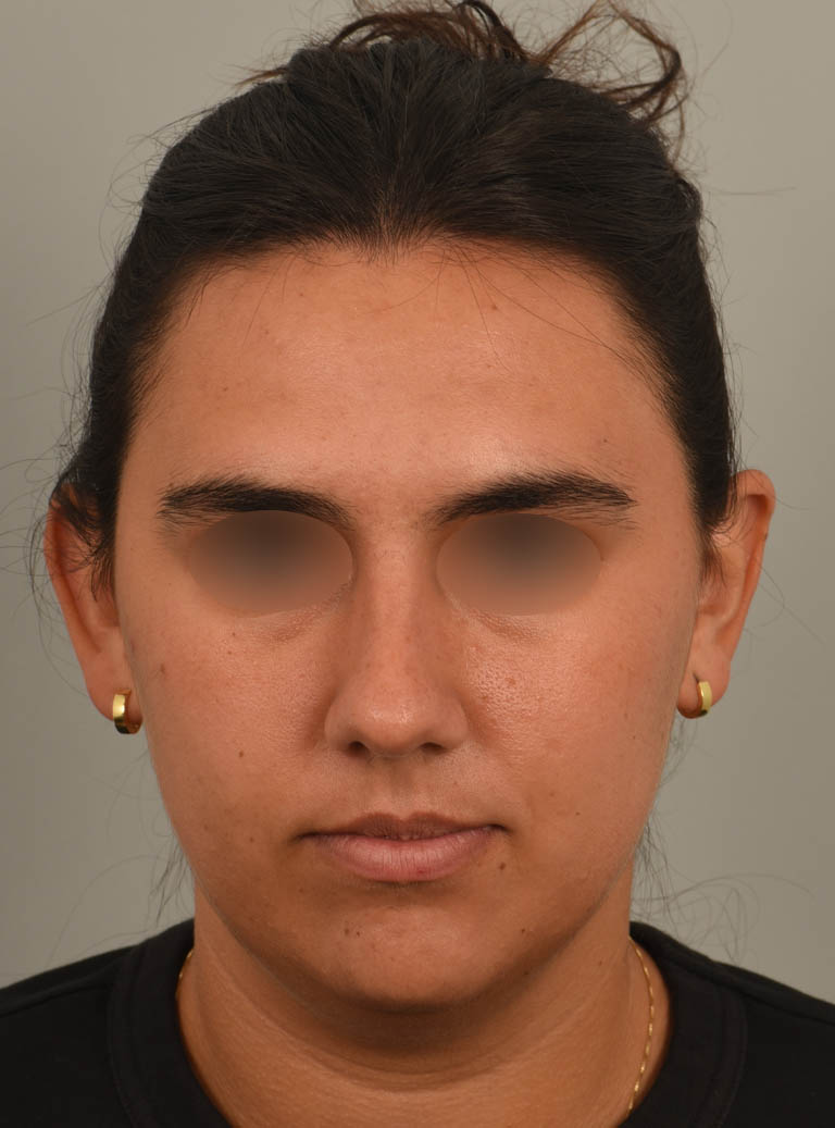 Buccal Fat Reduction case #11294