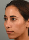 Rhinoplasty case #11722