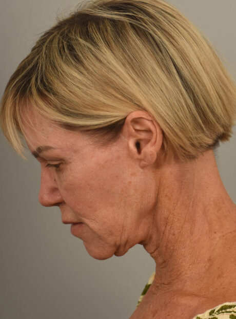 Facelift case #11486