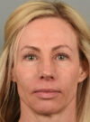 Eyelid Surgery case #11801