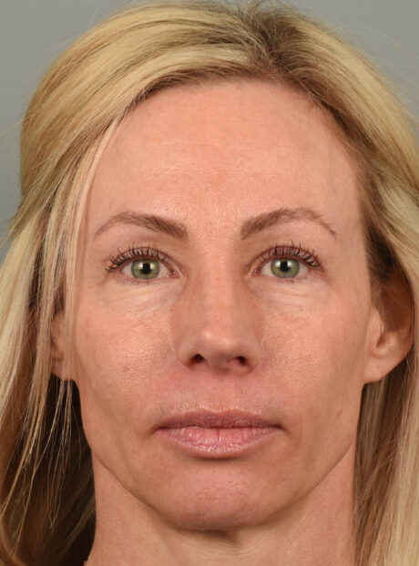 Eyelid Surgery case #11801