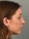 Chin Augmentation case #11702