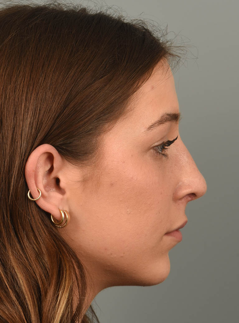 Chin Augmentation case #11702