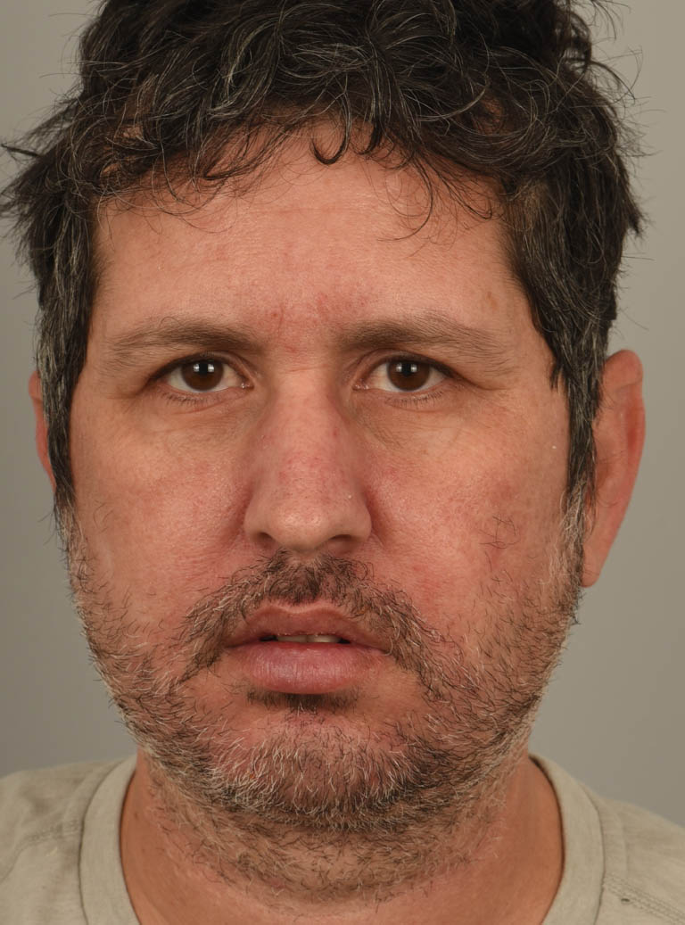 Chin Augmentation case #11311