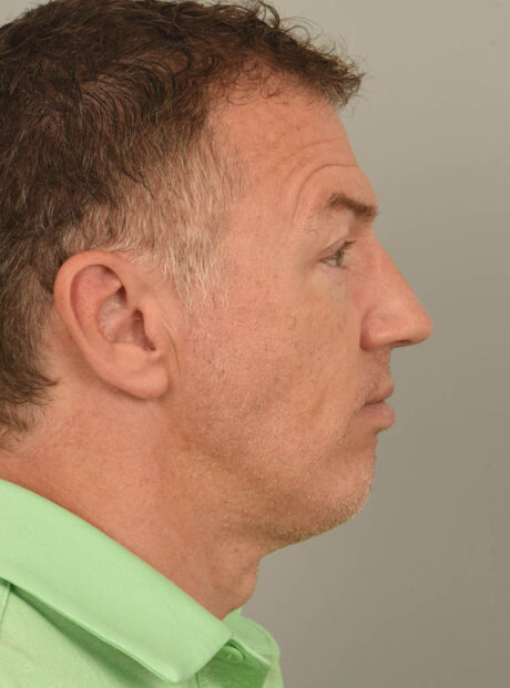 Chin Augmentation case #11371
