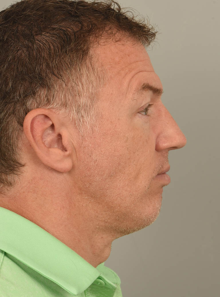 Chin Augmentation case #11371