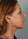 Eyelid Surgery case #11400