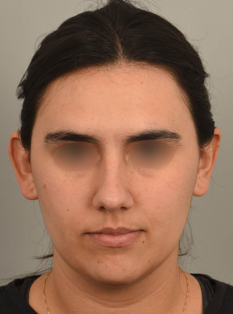 Buccal Fat Reduction case #11294