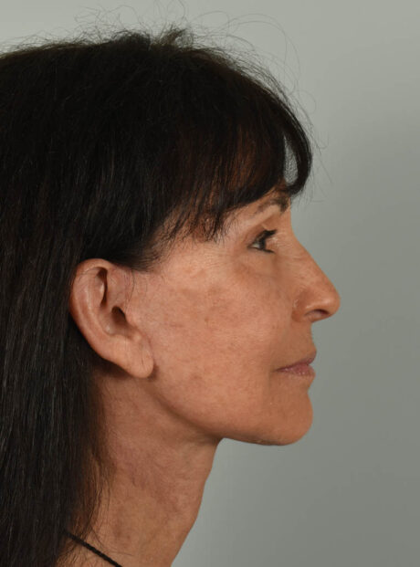 Facelift case #11514