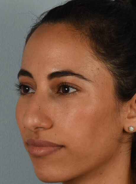 Rhinoplasty case #11722