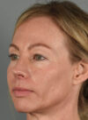 Eyelid Surgery case #11801