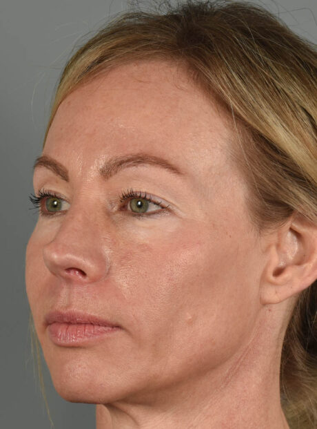 Eyelid Surgery case #11801
