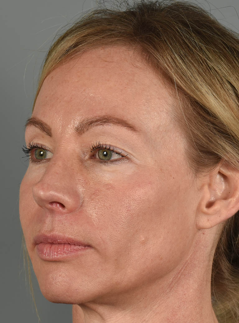 Eyelid Surgery case #11801