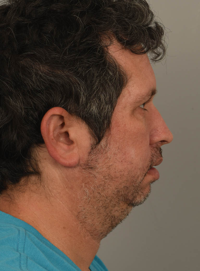 Chin Augmentation case #11311