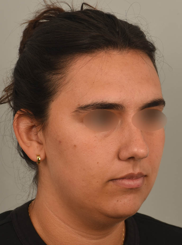 Buccal Fat Reduction case #11294