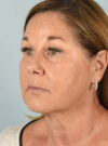 Eyelid Surgery case #11400
